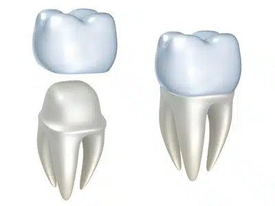 Gold vs. Porcelain crowns